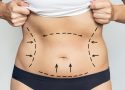 Après une perte de poids importante : quand l’abdominoplastie est-elle envisagée ?
