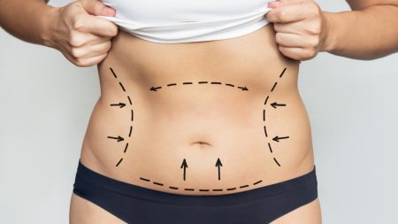 Après une perte de poids importante : quand l’abdominoplastie est-elle envisagée ?